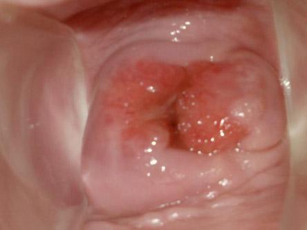 女人病的危害 宮頸糜爛有什么癥狀