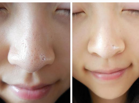 鼻子上有黑頭怎么辦  教你幾招