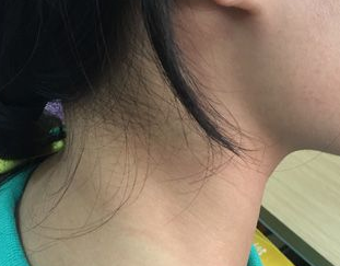 折磨人的咽喉炎，咽喉炎癥狀有哪些