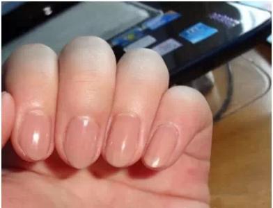 亞健康的表現(xiàn) 手指甲上有小坑
