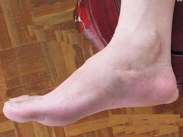 痛風(fēng)的治療方法 12個(gè)有效偏方推薦給你