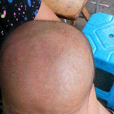 頭癬的癥狀和局部治療方法