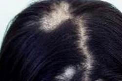 頭癬的癥狀和局部治療方法