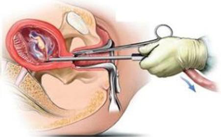來(lái)的不是時(shí)候 人流最佳時(shí)間