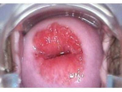 婦科炎癥宮頸肥大是怎么回事