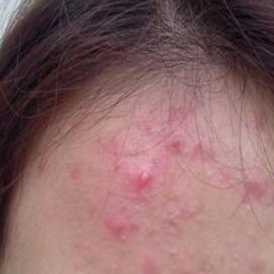 額頭長(zhǎng)痘痘怎么調(diào)理 教你幾招祛痘方法