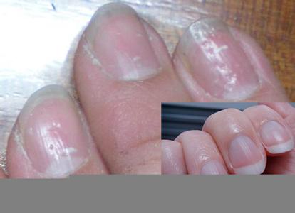 亞健康的表現(xiàn) 手指甲上有小坑