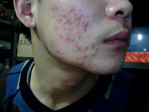 快速簡(jiǎn)單的祛痘方法 臉上長(zhǎng)痘痘怎么快速去除