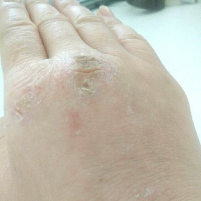 冬天皮膚瘙癢怎么辦  9種方法