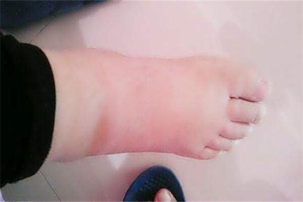 腳腫了怎么辦 腳腫的原因
