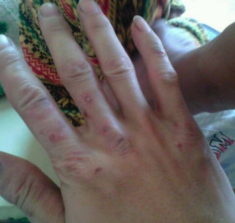 濕疹怎么辦 治療濕疹的偏方讓你遠(yuǎn)離該病