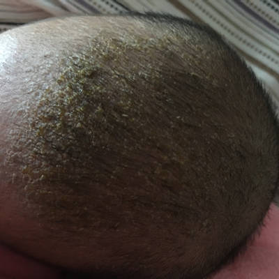 教你了解脂溢性皮炎及其治療方法