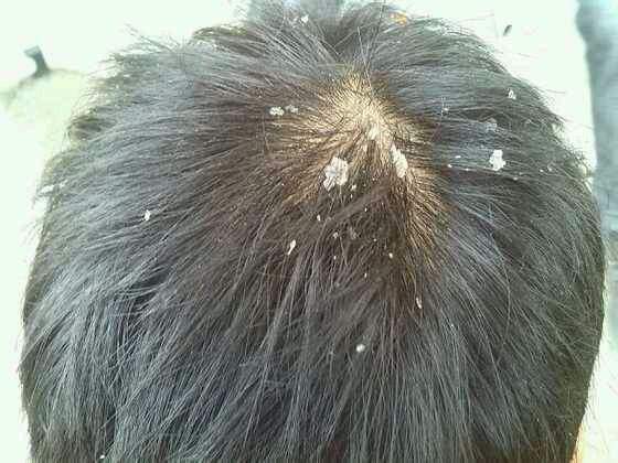 頭屑多是什么原因 中醫(yī)6偏方幫你去頭屑