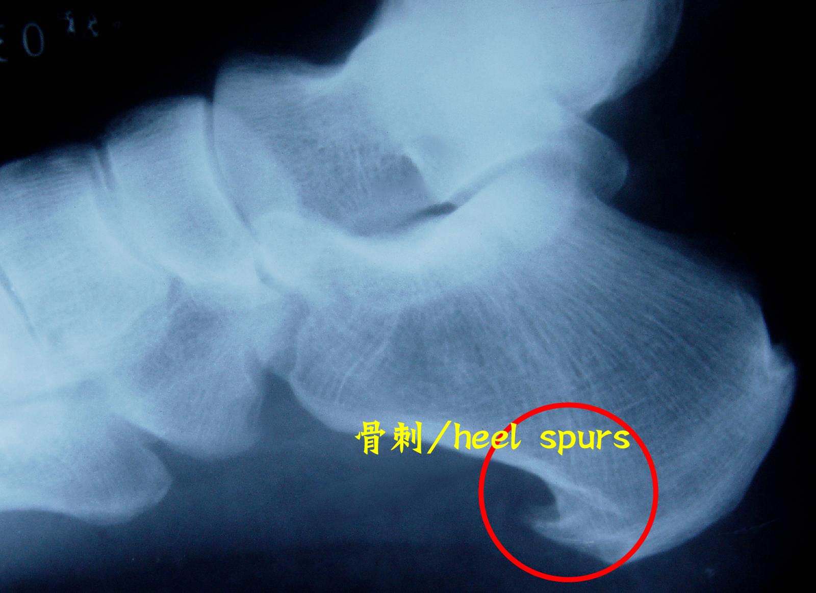 骨刺到底是不是病，治療骨刺的偏方