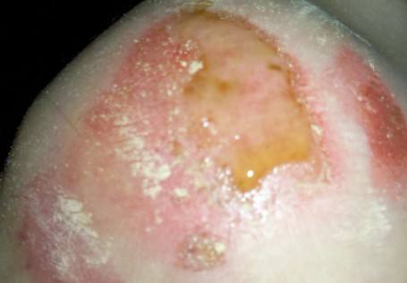 傷口發(fā)炎怎么辦 幫助傷口愈合的食物