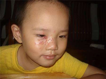 皰疹7大病因及治療皰疹的最好方法