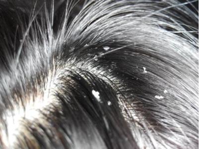 頭屑多是什么原因 中醫(yī)6偏方幫你去頭屑