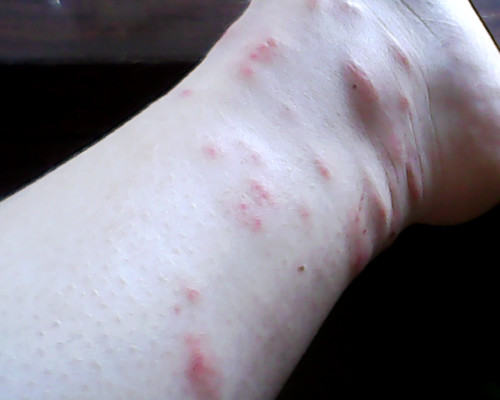 皮膚過敏了怎么辦？這可不是小事