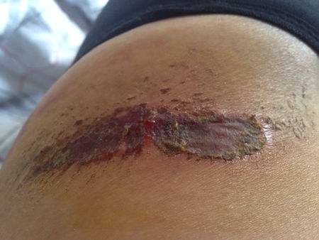 傷口發(fā)炎怎么辦 幫助傷口愈合的食物