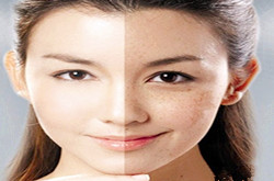 討厭的黃褐斑，中醫(yī)祛黃褐斑