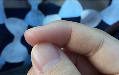 肝臟不好的癥狀 指甲癥狀尤為明顯