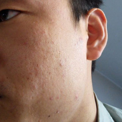 臉上有痘坑 最有效的5種方法