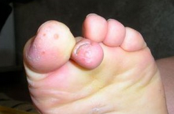 教你腳氣腳臭7種治理方法