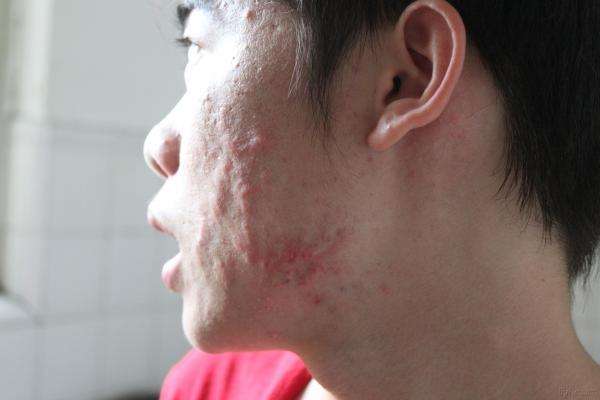 痤瘡怎樣治 日常護(hù)理和藥物治療方法