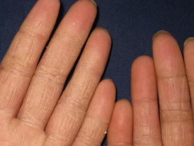 手足癬日常護(hù)理措施和治療工作大全