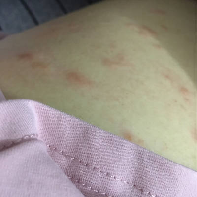 入秋后我們感覺身上癢是怎么回事