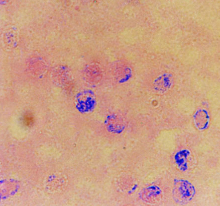 丹毒的癥狀  一般出現(xiàn)在小腿、臉部