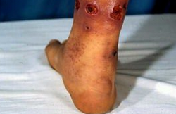 丹毒的癥狀  一般出現(xiàn)在小腿、臉部