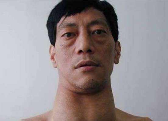 甲亢的癥狀有哪些及最佳的治療方式