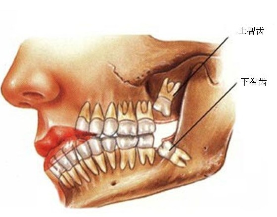 智齒發(fā)炎 注重口腔衛(wèi)生問(wèn)題