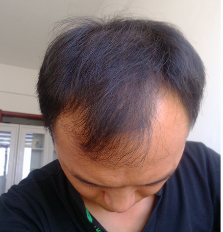 很多人都想知道怎樣治療脫發(fā)