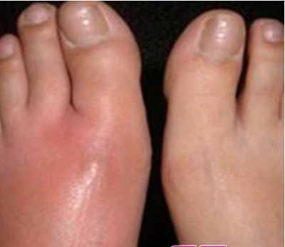 丹毒的癥狀  一般出現(xiàn)在小腿、臉部