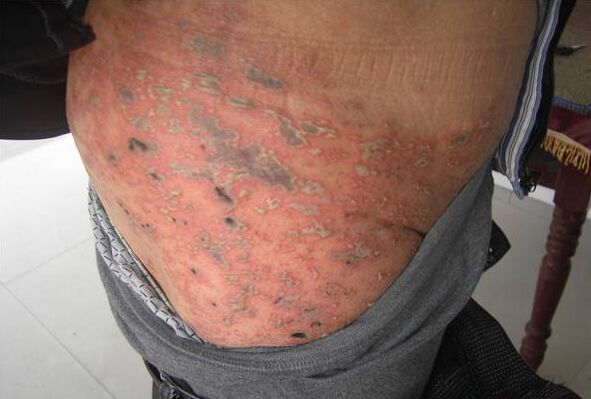 帶狀皰疹怎么治療 西藥治療帶狀皰疹的方法