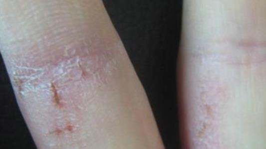 15個手部濕疹偏方及常見的幾種療法