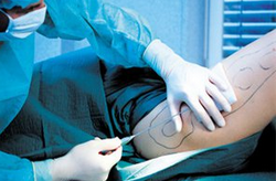 抽脂的危害  五種危害你知道嗎