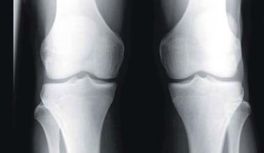 骨刺到底是不是病，治療骨刺的偏方