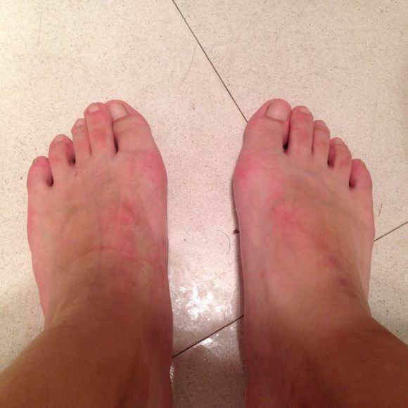 痛風是什么？5大治療痛風偏方獻給你