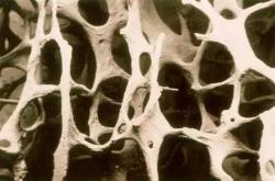 青少年骨質(zhì)疏松吃什么能更快康復