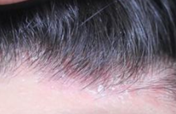 教你了解脂溢性皮炎及其治療方法