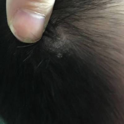 教你了解脂溢性皮炎及其治療方法