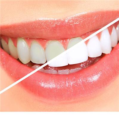 愛美的朋友不要錯過，怎么讓牙齒變白