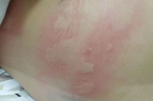 蕁麻疹的癥狀 主要有以下六種