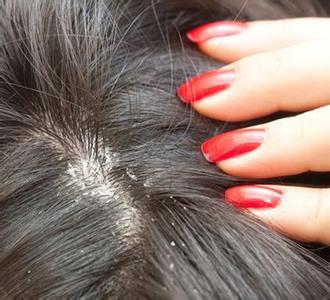 如何快速去除頭皮屑 對頭皮屑3大誤區(qū)