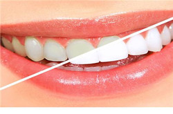 愛美的朋友不要錯過，怎么讓牙齒變白