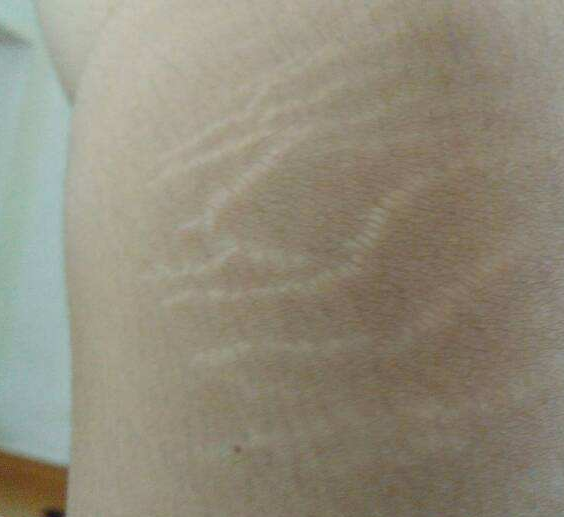 愛美女生關(guān)注的生長(zhǎng)紋怎么去除