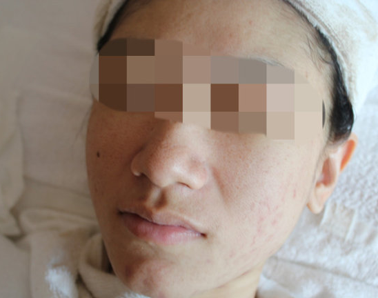 女性朋友最關(guān)注怎么除痘坑的問題